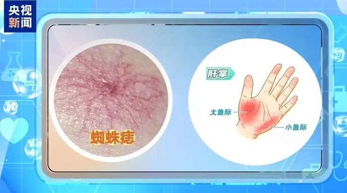 全国爱肝日：出现这些症状，是肝脏在向你“呼救”